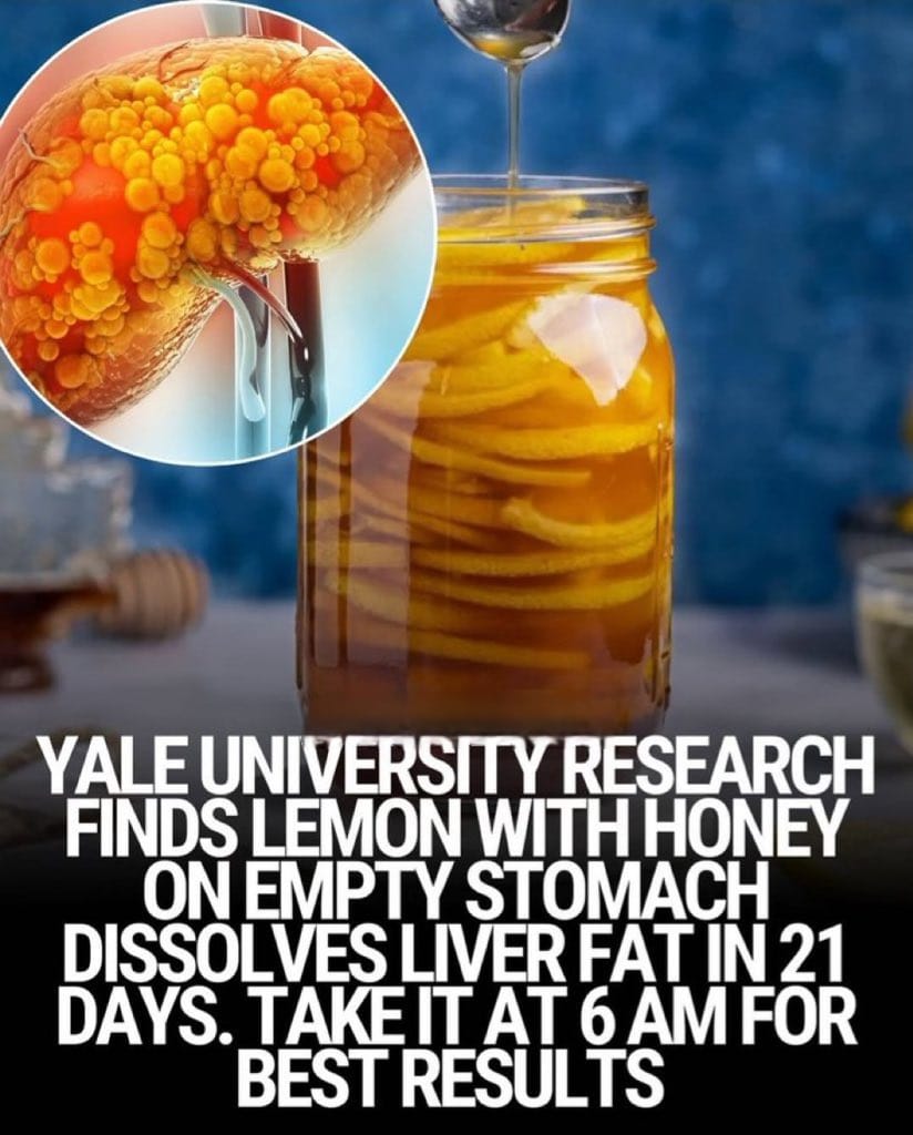 Does Lemon and Honey on an Empty Stomach Dissolve Liver Fat in 21 Days?