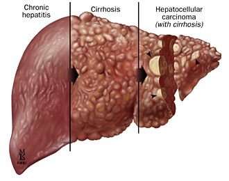 7-early-signs-that-your-liver-is-quietly-starting-to-fail